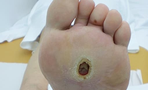 Diabetic-foot-ulcer.jpg