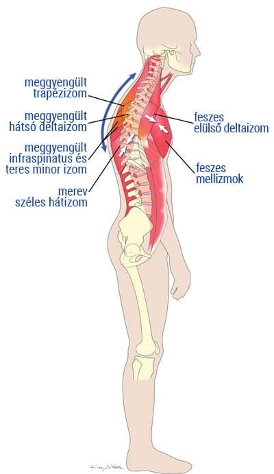 Forward‑tilted head illustration
