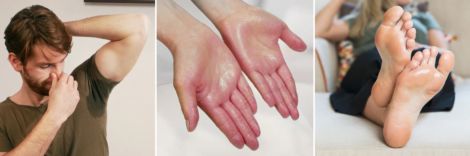 Hyperhidrosis - abnormal palm and sole sweating