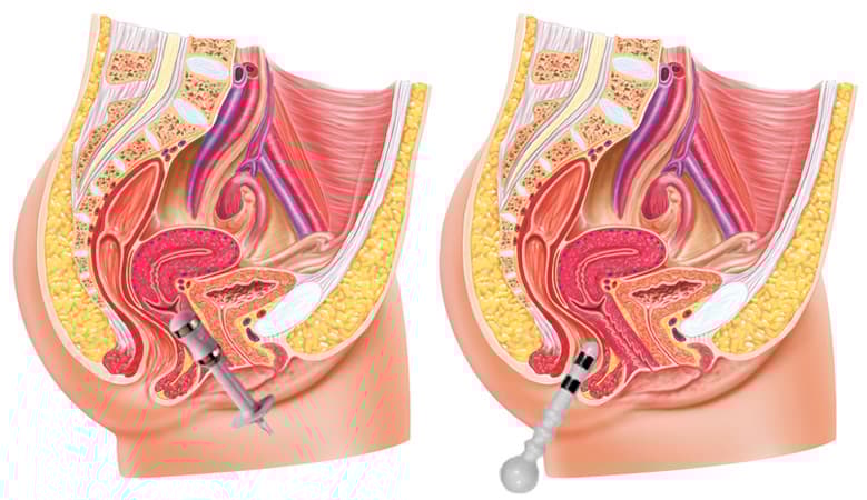 Incontinence treatment – vaginal and rectal probe positions