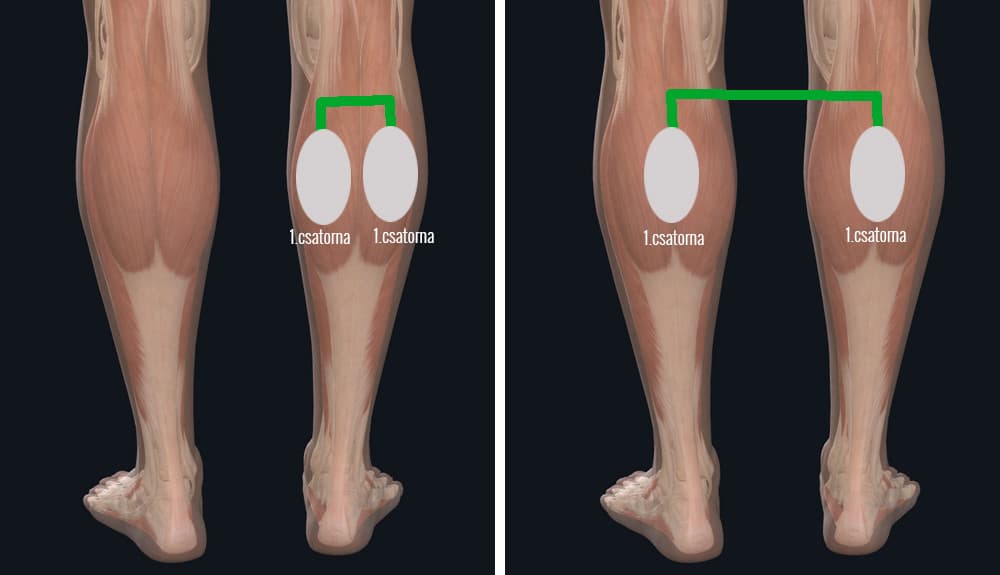 placement of electrodes for treatment with Veinoplus Arterial, Veinoplus V.I. and Veinoplus DVT devices