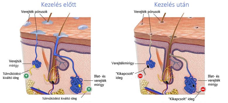 sweat glands before and after tap water iontophoresis treatment