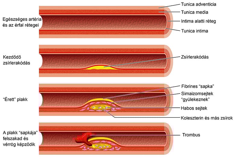 atherosclerosis