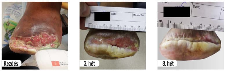 ulcer treatment results with B-Cure softlaser device