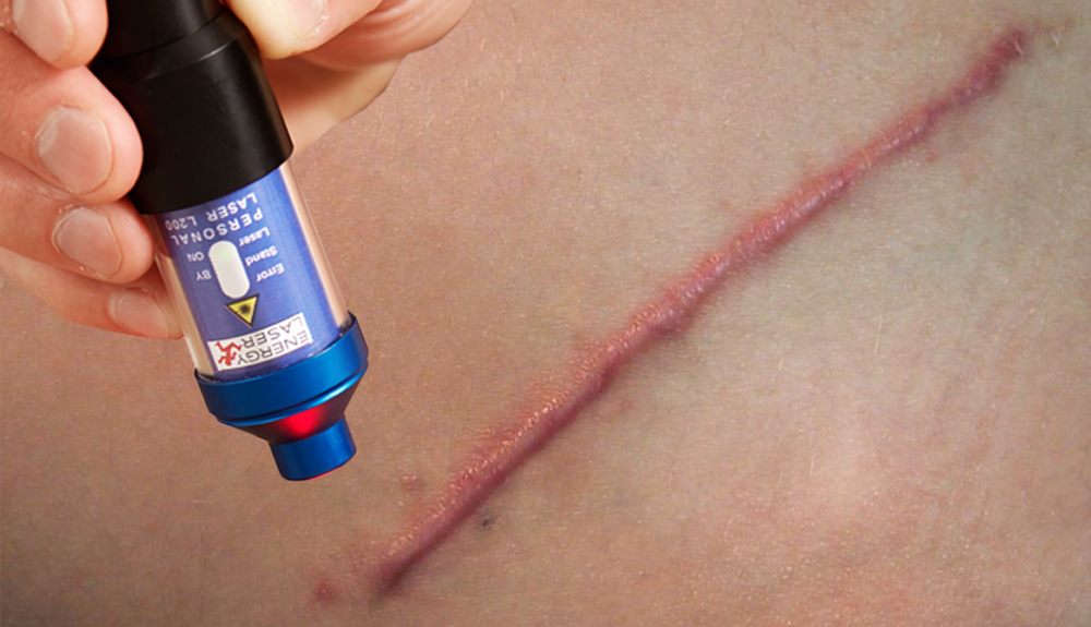 keloid treatment with softlaser.jpg