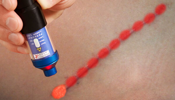 keloid treatment points with softlaser.jpg