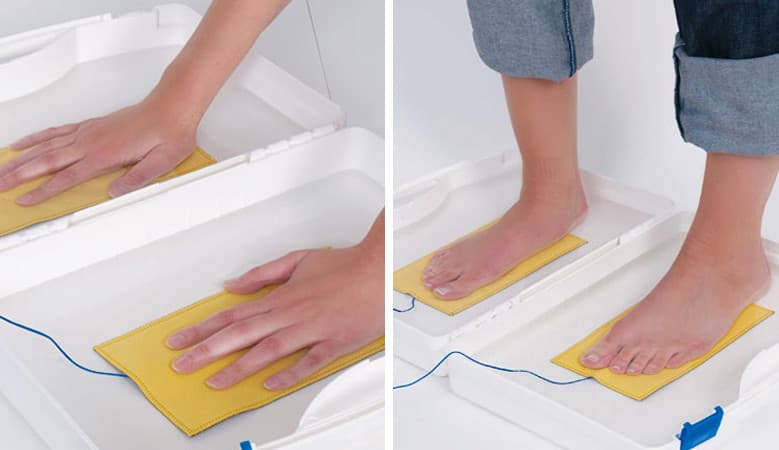 treatment of abnormal hand and foot sweating with iontophoresis