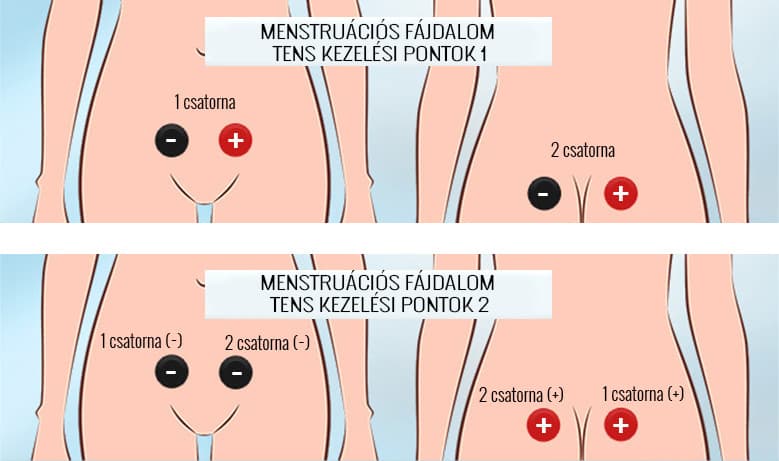 TENS treatment points for menstrual cramps