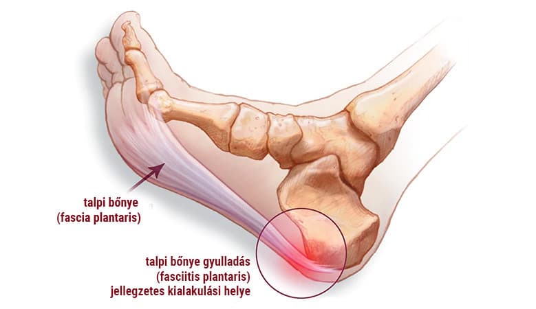 plantar fascia inflammation, plantar fasciitis
