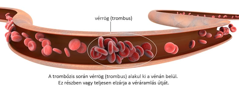 thrombus-that-is-formation-of-a-blood-clot.jpg