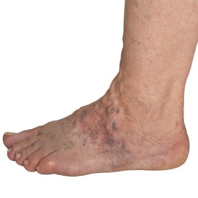 Product recommendation for post-thrombotic syndrome treatment