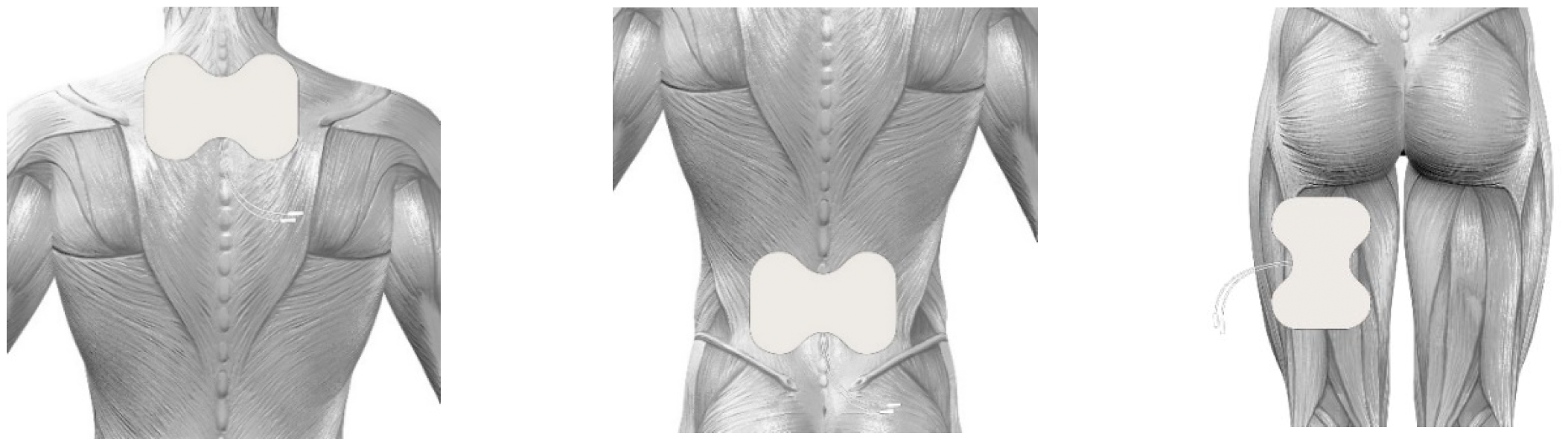 Butterfly electrode