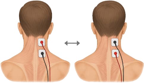 Electrode polarity in electrotherapy – when does it matter, when not?